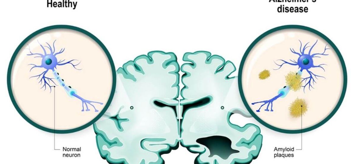 Alzheimer’s Disease – Everything you need to know about it