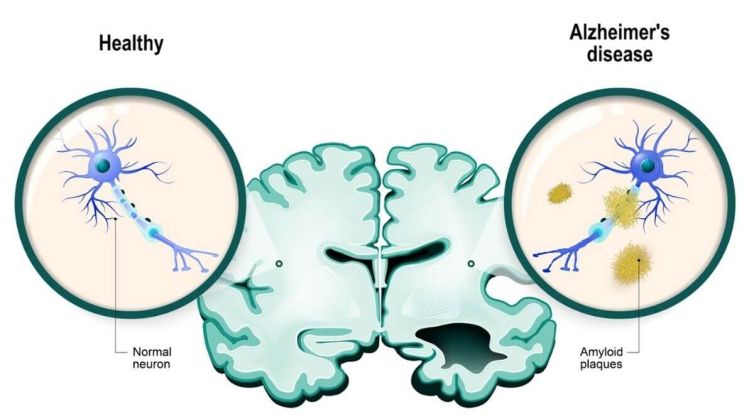 Alzheimer&rsquo;s Disease &ndash; Everything you need to know about it