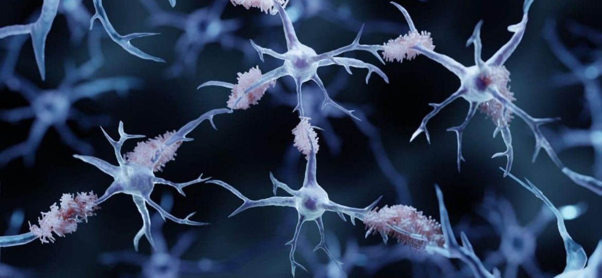 What Role Does Alpha-synuclein Play in Alzheimer’s Disease?