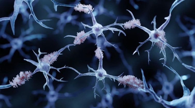 What Role Does Alpha-synuclein Play in Alzheimer&rsquo;s Disease?