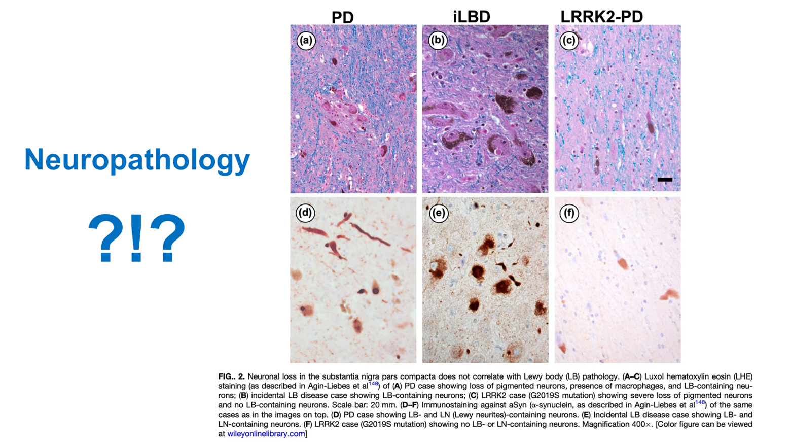 Alpha-synuclein accumulation linked to neurodegeneration in Parkinson’s patients